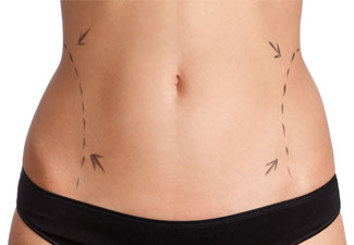 image of a tummy tuck markings