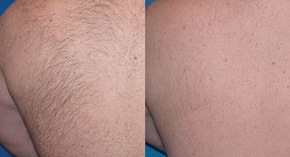 Laser Hair Removal | Aesthetic Treatments