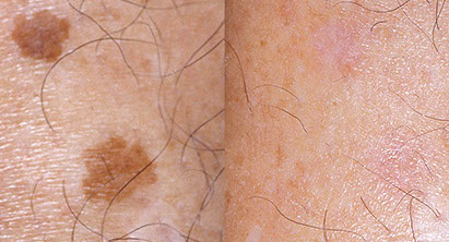 before and after laser skin resurfacing dark spots