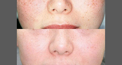 laser skin resurfacing freckles