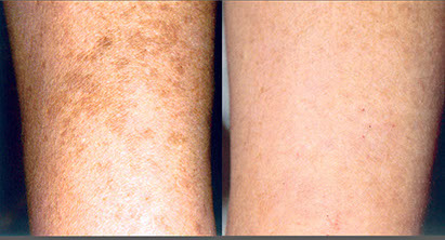 before and after laser skin resurfacing