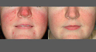 before and after laser skin resurfacing on rosacea