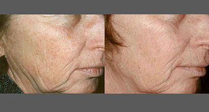 before and after laser skin resurfacing wrinkles