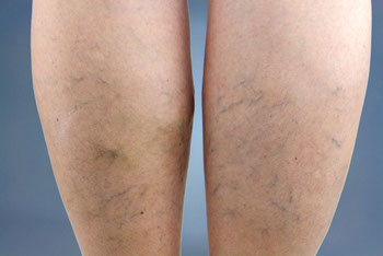 leg vein treatment